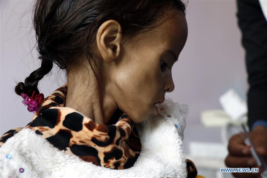 YEMEN-SANAA-CHILDREN-MALNUTRITION